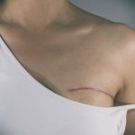 В Саратовской области женщине вырезали грудь из-за ошибки врачей